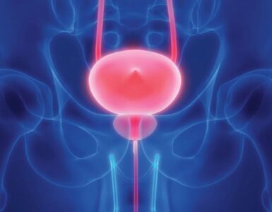 Marcadores moleculares del cáncer de próstata 3 Cancer de prostata
