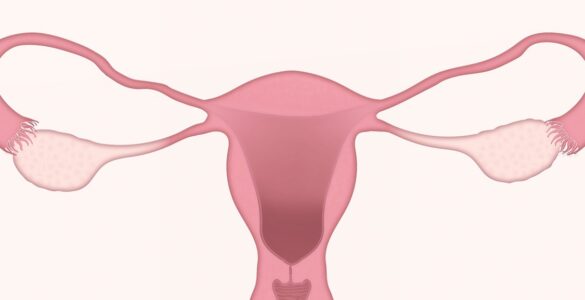 Quimioterapia en cáncer de ovario 1 Quimioterapia