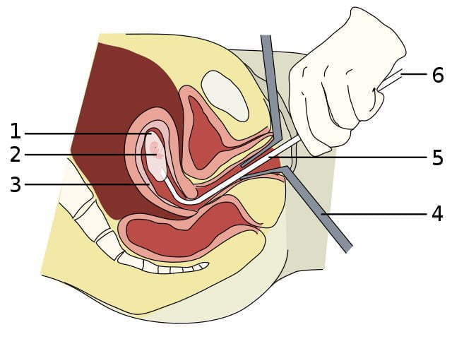 aborto Aborto 1