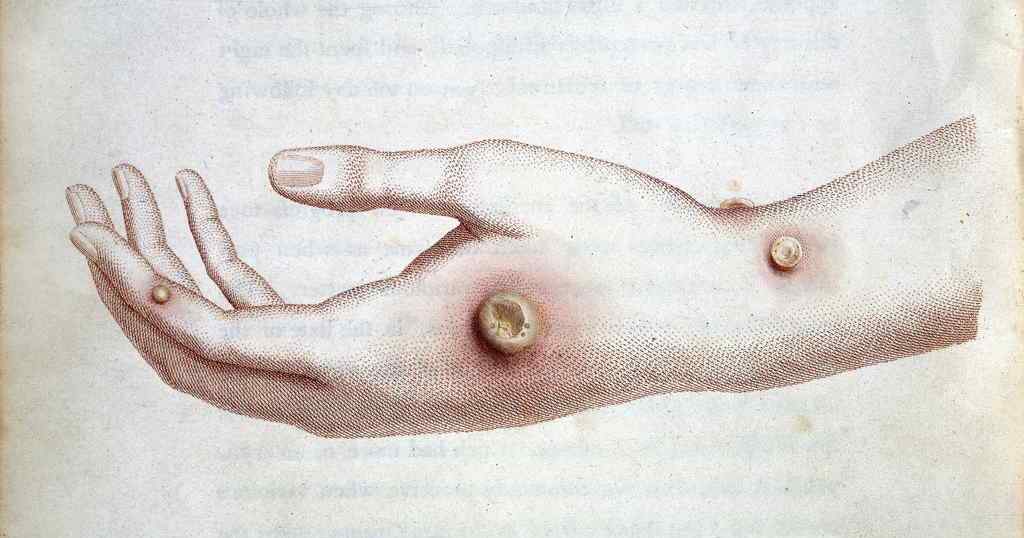 Viruela